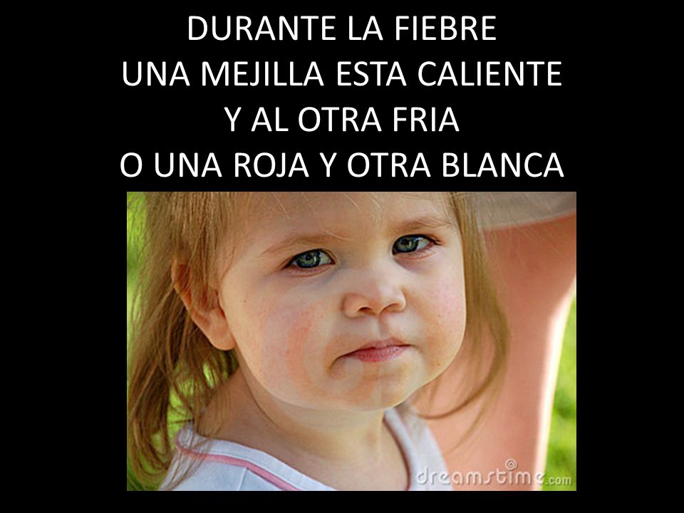 DURANTE LA FIEBRE UNA MEJILLA ESTA CALIENTE Y AL OTRA FRIA O UNA ROJA Y OTRA BLANCA