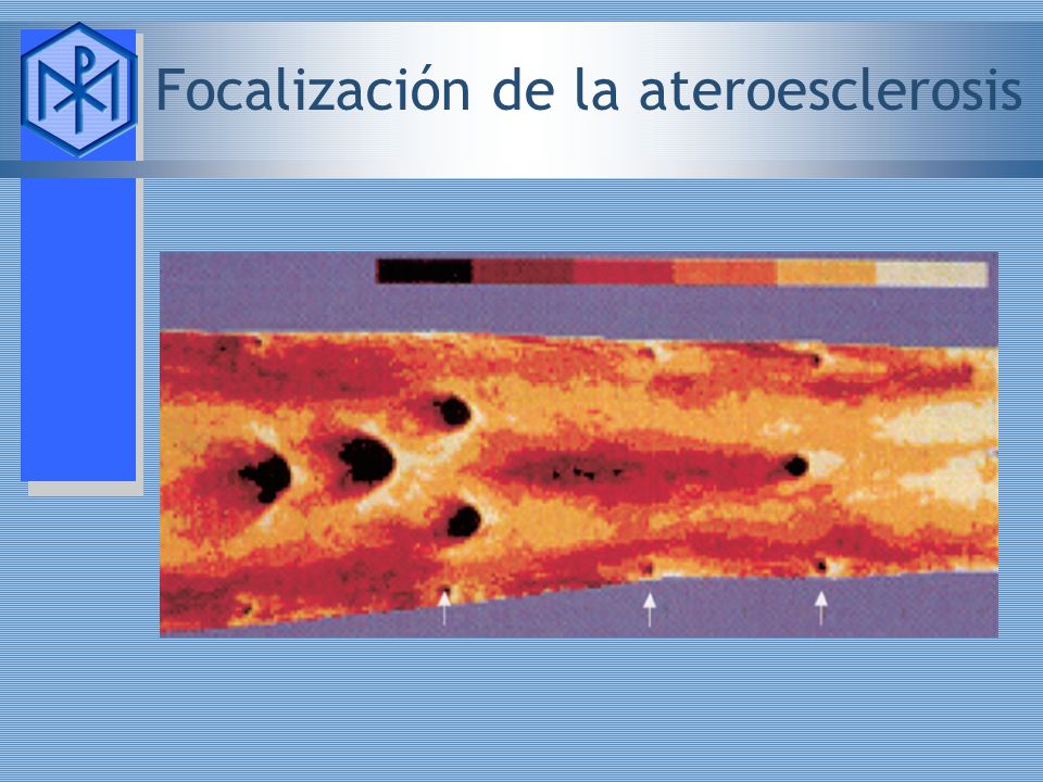 Focalización de la ateroesclerosis