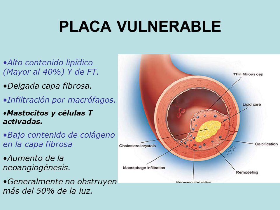 PLACA VULNERABLE Alto contenido lipídico (Mayor al 40%) Y de FT.