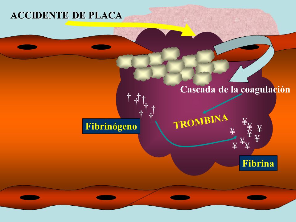 ACCIDENTE DE PLACA Cascada de la coagulación. † † † † † † † † TROMBINA. ¥ Fibrinógeno. ¥