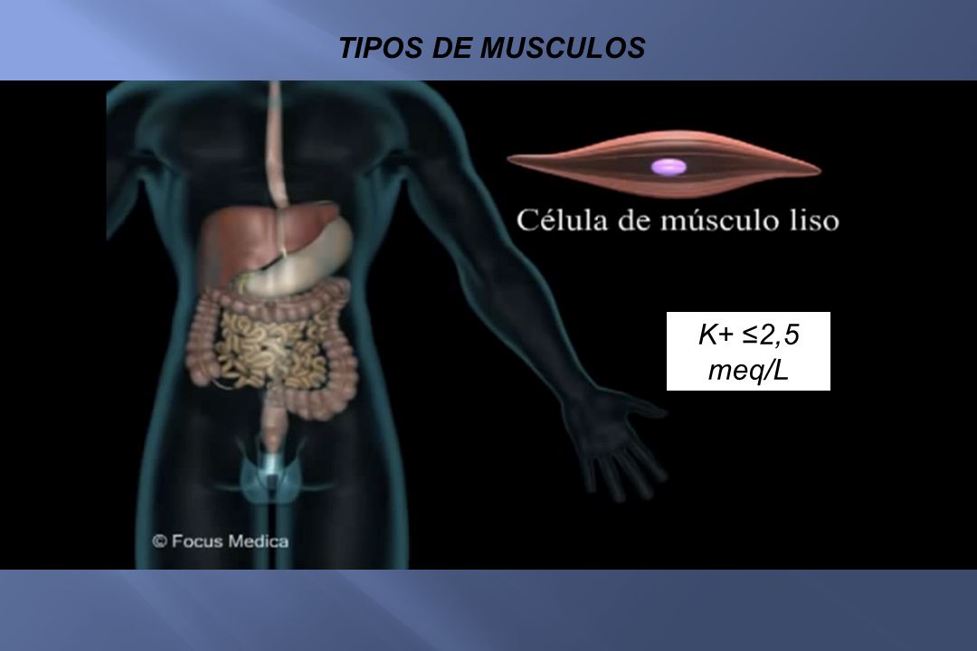 TIPOS DE MUSCULOS K+ ≤2,5 meq/L