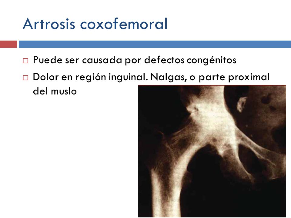 Artrosis coxofemoral Puede ser causada por defectos congénitos