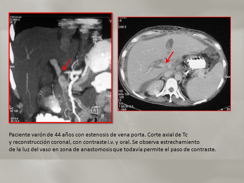 Paciente varón de 44 años con estenosis de vena porta