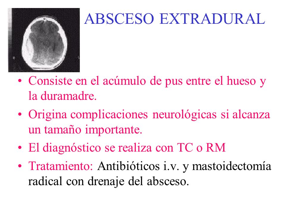 ABSCESO EXTRADURAL Consiste en el acúmulo de pus entre el hueso y la duramadre. Origina complicaciones neurológicas si alcanza un tamaño importante.