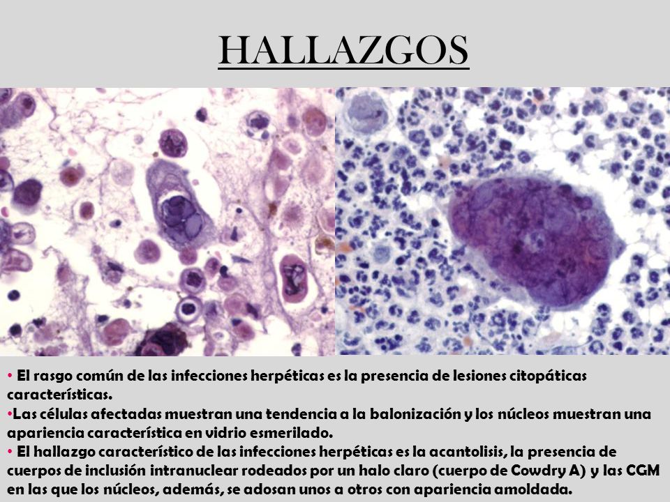 HALLAZGOS El rasgo común de las infecciones herpéticas es la presencia de lesiones citopáticas características.