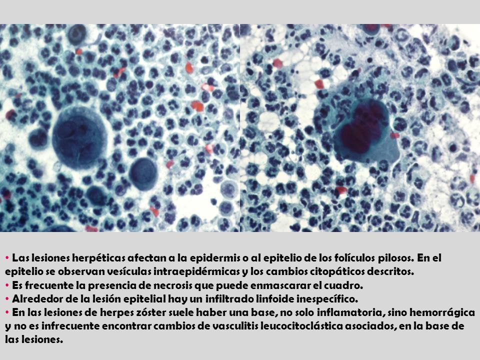 Las lesiones herpéticas afectan a la epidermis o al epitelio de los folículos pilosos. En el epitelio se observan vesículas intraepidérmicas y los cambios citopáticos descritos.