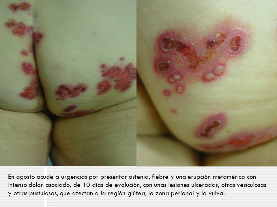 En agosto acude a urgencias por presentar astenia, fiebre y una erupción metamérica con intenso dolor asociado, de 10 días de evolución, con unas lesiones ulceradas, otras vesiculosas y otras pustulosas, que afectan a la región glútea, la zona perianal y la vulva.