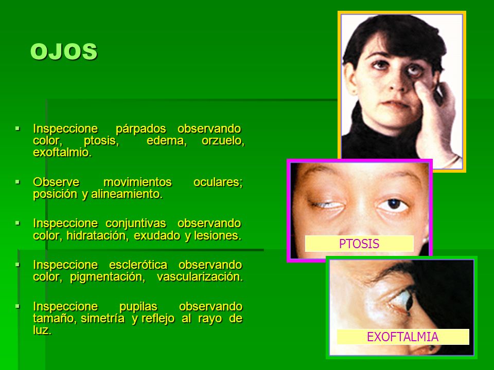 OJOS Inspeccione párpados observando color, ptosis, edema, orzuelo, exoftalmio.