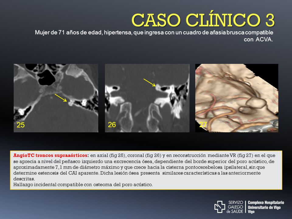CASO CLÍNICO 3 Mujer de 71 años de edad, hipertensa, que ingresa con un cuadro de afasia brusca compatible con ACVA.