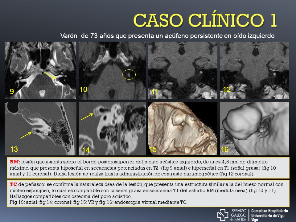 CASO CLÍNICO 1 Varón de 73 años que presenta un acúfeno persistente en oído izquierdo