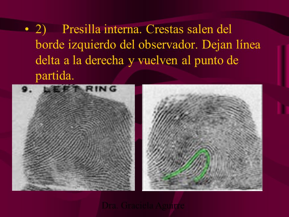2) Presilla interna. Crestas salen del borde izquierdo del observador