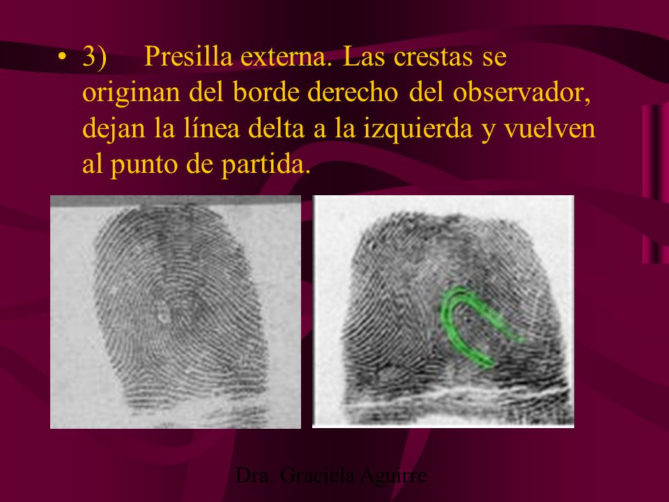 3) Presilla externa. Las crestas se originan del borde derecho del observador, dejan la línea delta a la izquierda y vuelven al punto de partida.