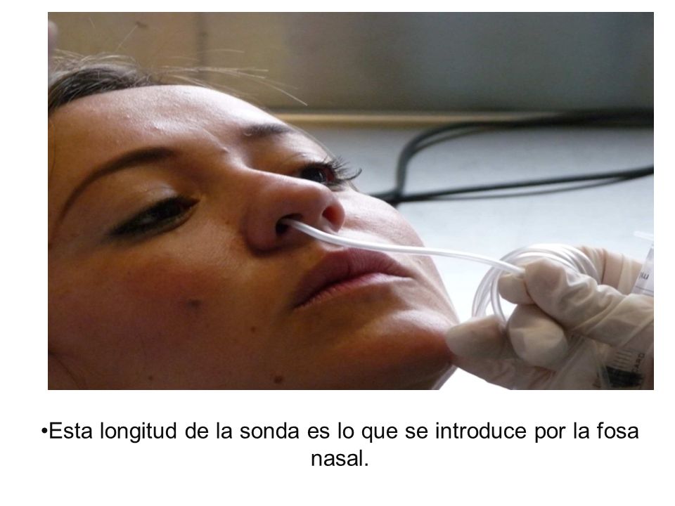 Esta longitud de la sonda es lo que se introduce por la fosa nasal.