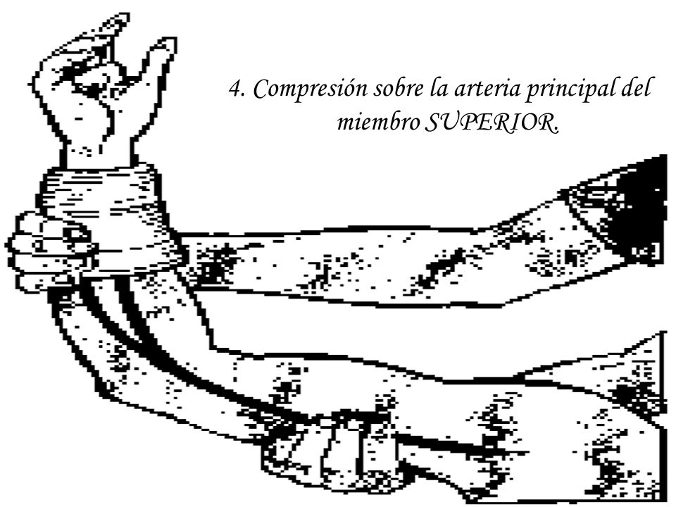 4. Compresión sobre la arteria principal del miembro SUPERIOR.