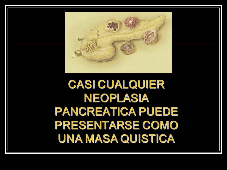 CASI CUALQUIER NEOPLASIA PANCREATICA PUEDE PRESENTARSE COMO UNA MASA QUISTICA