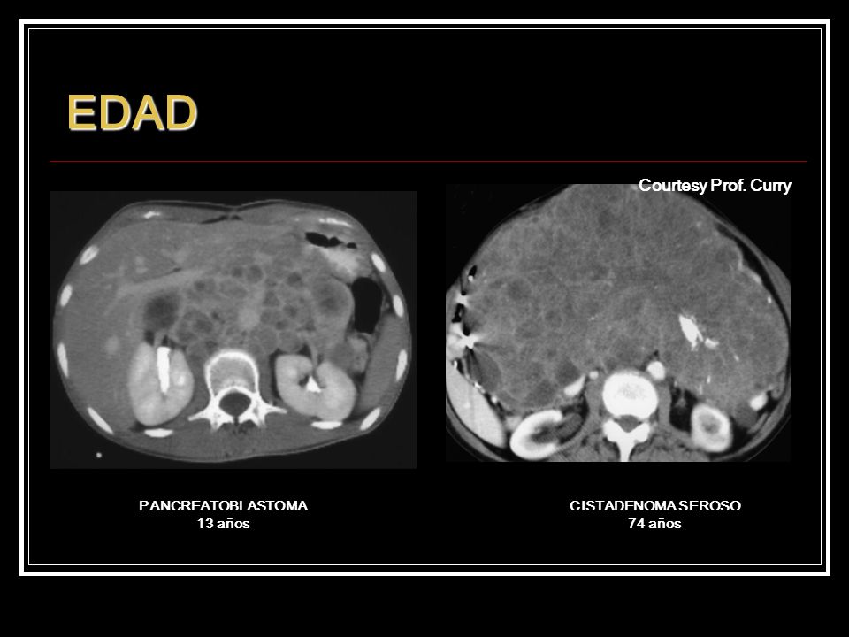 EDAD Courtesy Prof. Curry Insulinoma. Secuencia Turbo espín eco T2