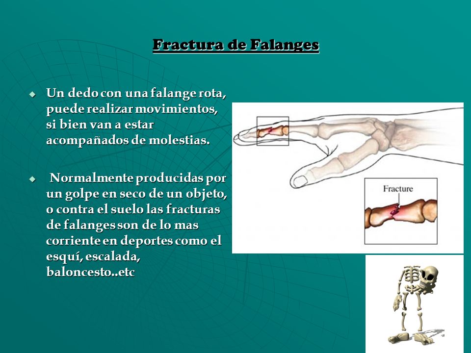 Fractura de Falanges Un dedo con una falange rota, puede realizar movimientos, si bien van a estar acompañados de molestias.