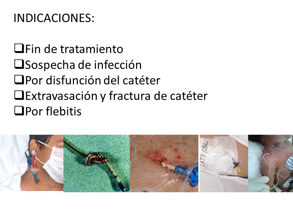 INDICACIONES: Fin de tratamiento. Sospecha de infección. Por disfunción del catéter. Extravasación y fractura de catéter.