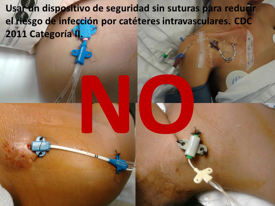 Usar un dispositivo de seguridad sin suturas para reducir el riesgo de infección por catéteres intravasculares. CDC 2011 Categoría II.