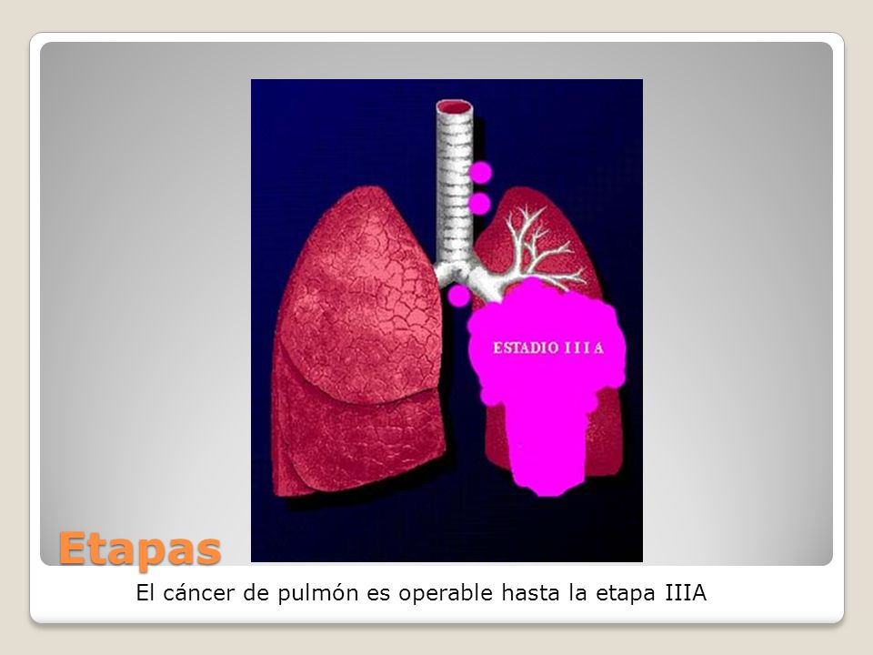 Etapas El cáncer de pulmón es operable hasta la etapa IIIA
