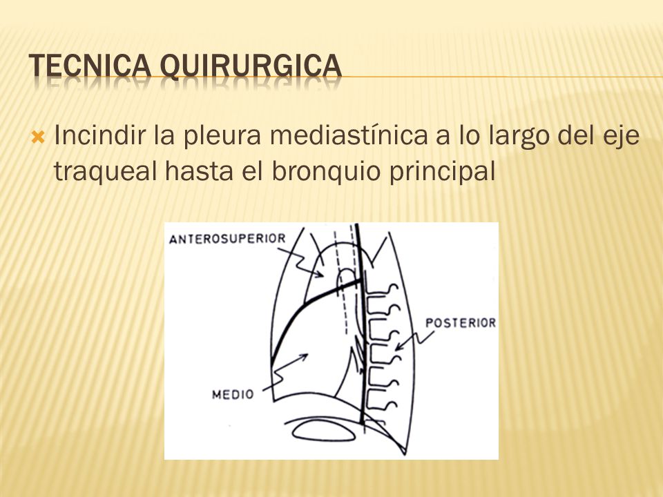 Tecnica quirurgica Incindir la pleura mediastínica a lo largo del eje traqueal hasta el bronquio principal.