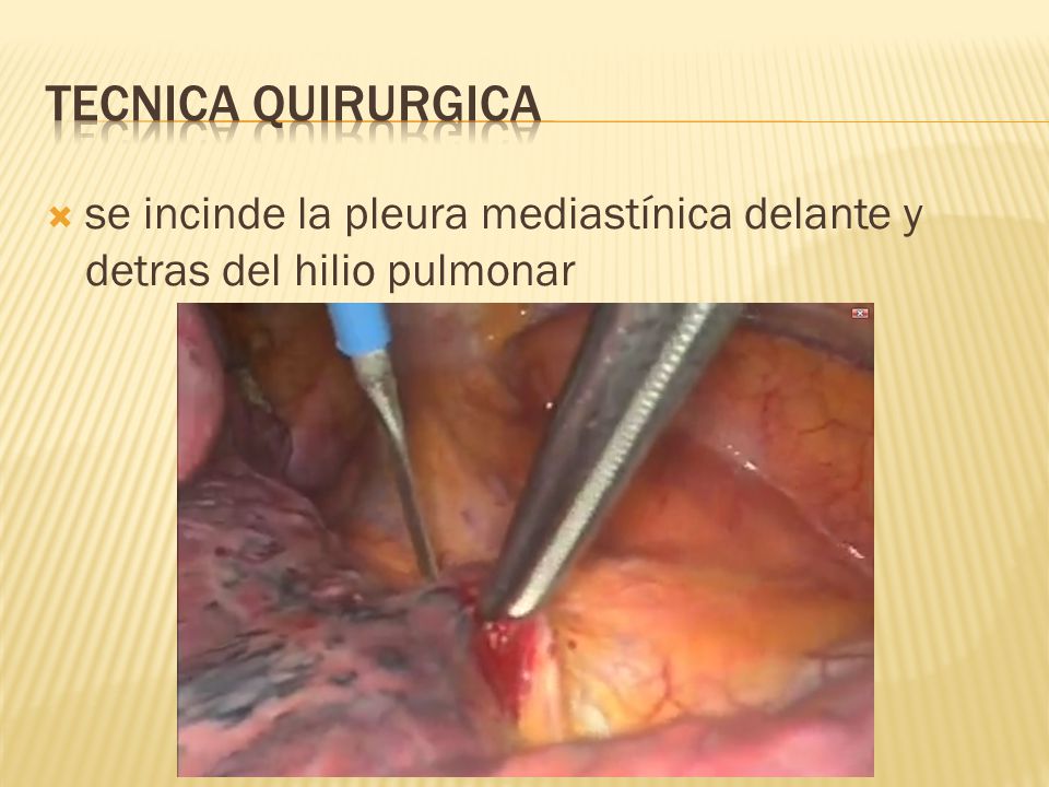 Tecnica quirurgica se incinde la pleura mediastínica delante y detras del hilio pulmonar