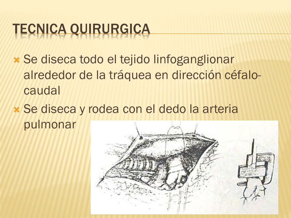 Tecnica quirurgica Se diseca todo el tejido linfoganglionar alrededor de la tráquea en dirección céfalo-caudal.