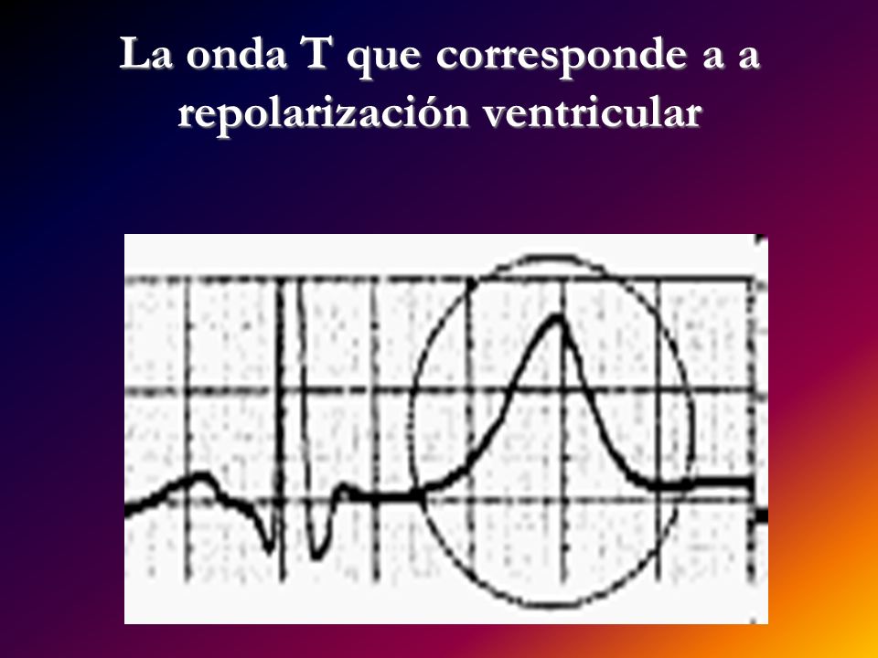 La onda T que corresponde a a repolarización ventricular
