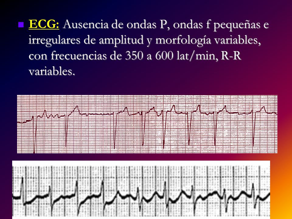 ECG: Ausencia de ondas P, ondas f pequeñas e irregulares de amplitud y morfología variables, con frecuencias de 350 a 600 lat/min, R-R variables.