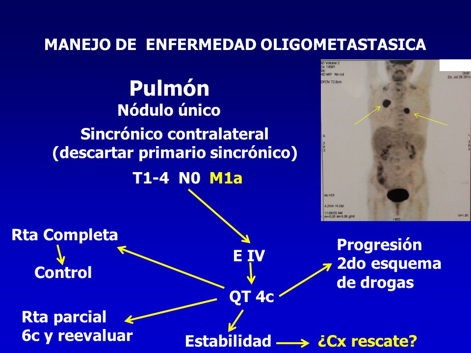 Pulmón MANEJO DE ENFERMEDAD OLIGOMETASTASICA Nódulo único