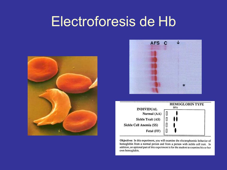 Electroforesis de Hb