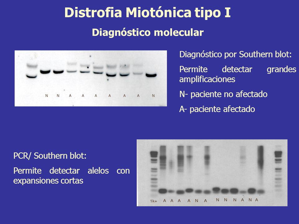 Distrofia Miotónica tipo I Diagnóstico molecular
