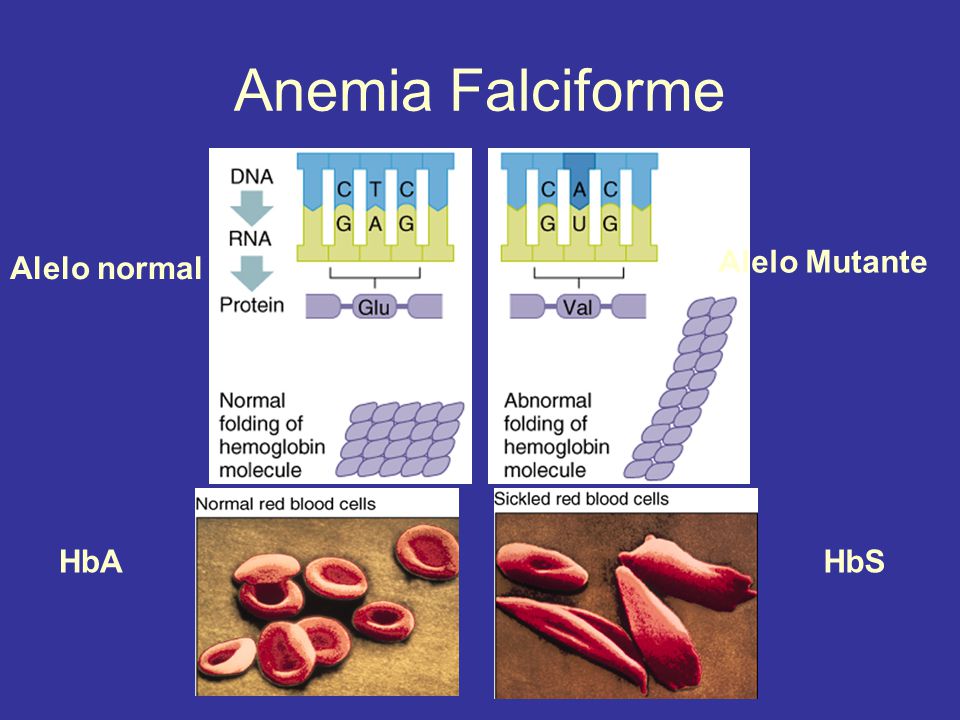 Anemia Falciforme Alelo normal Alelo Mutante HbA HbS