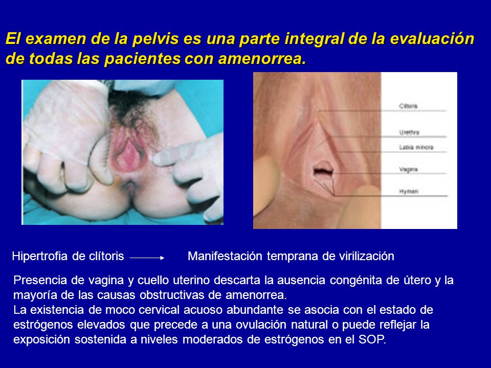 El examen de la pelvis es una parte integral de la evaluación de todas las pacientes con amenorrea.