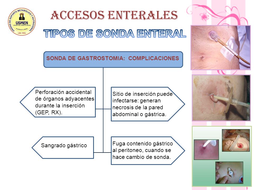 ACCESOS ENTERALES TIPOS DE SONDA ENTERAL