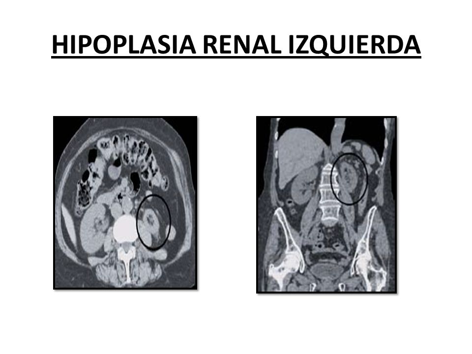 HIPOPLASIA RENAL IZQUIERDA