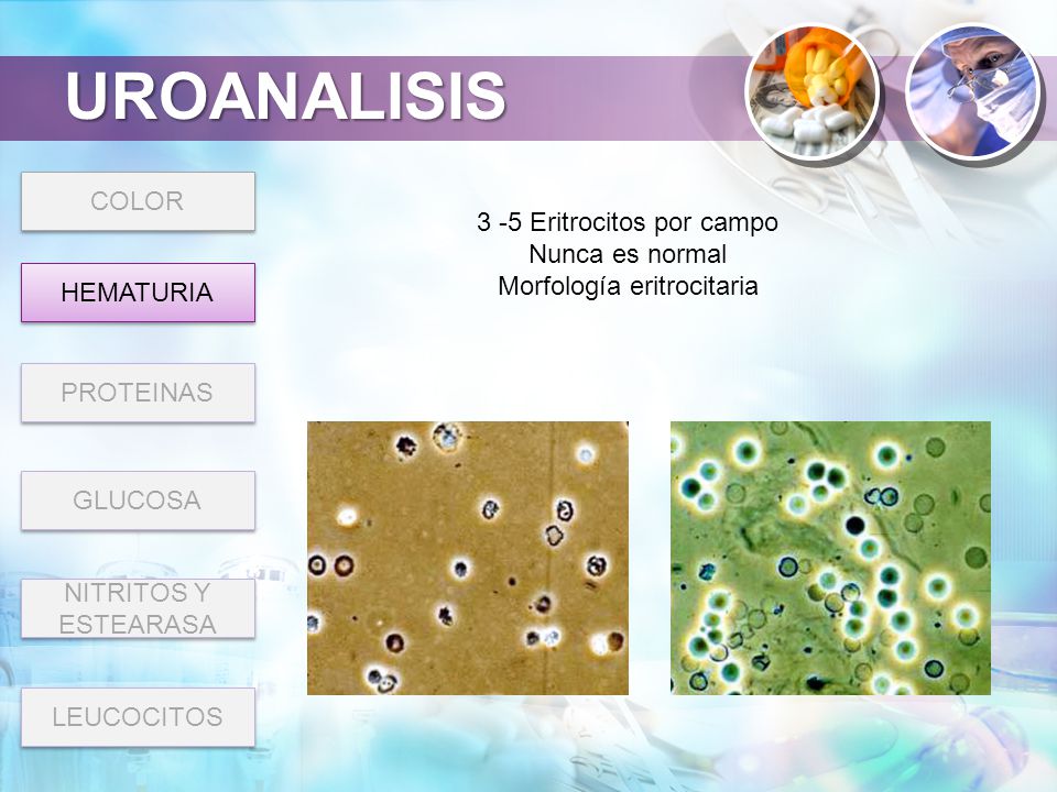 UROANALISIS COLOR 3 -5 Eritrocitos por campo Nunca es normal