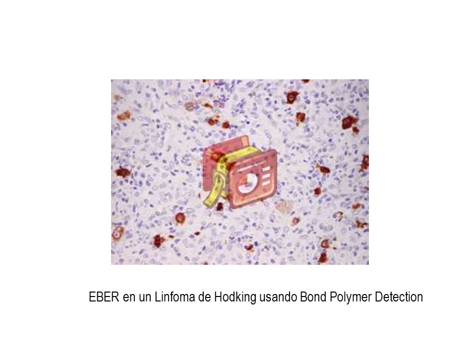 EBER en un Linfoma de Hodking usando Bond Polymer Detection