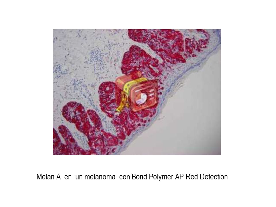 Melan A en un melanoma con Bond Polymer AP Red Detection