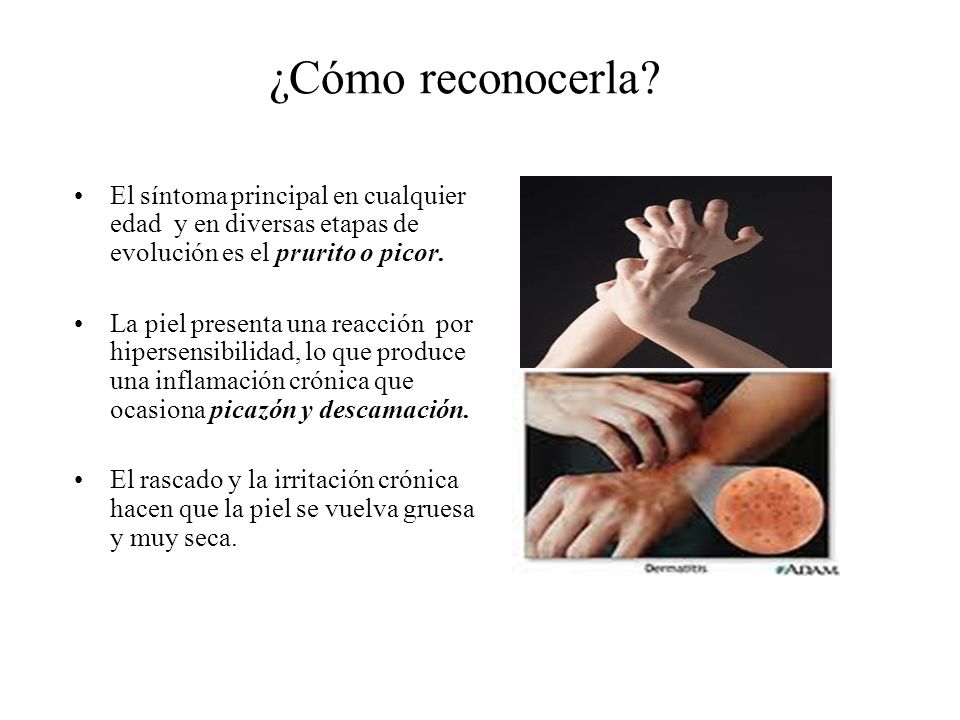 ¿Cómo reconocerla El síntoma principal en cualquier edad y en diversas etapas de evolución es el prurito o picor.