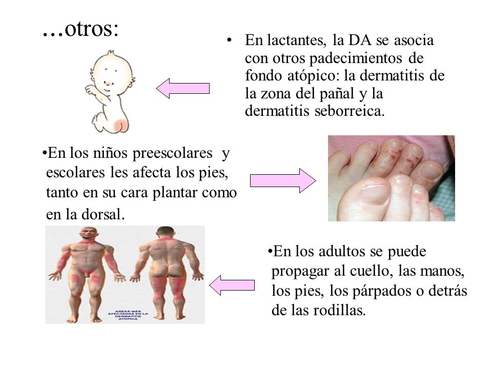...otros: En lactantes, la DA se asocia con otros padecimientos de fondo atópico: la dermatitis de la zona del pañal y la dermatitis seborreica.