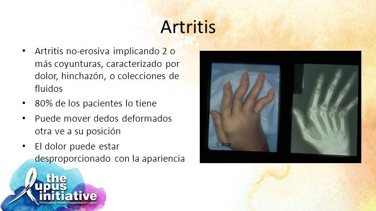 Artritis Artritis no-erosiva implicando 2 o más coyunturas, caracterizado por dolor, hinchazón, o colecciones de fluidos.