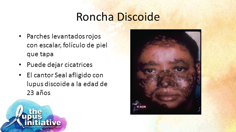 Roncha Discoide Parches levantados rojos con escalar, folículo de piel que tapa. Puede dejar cicatrices.