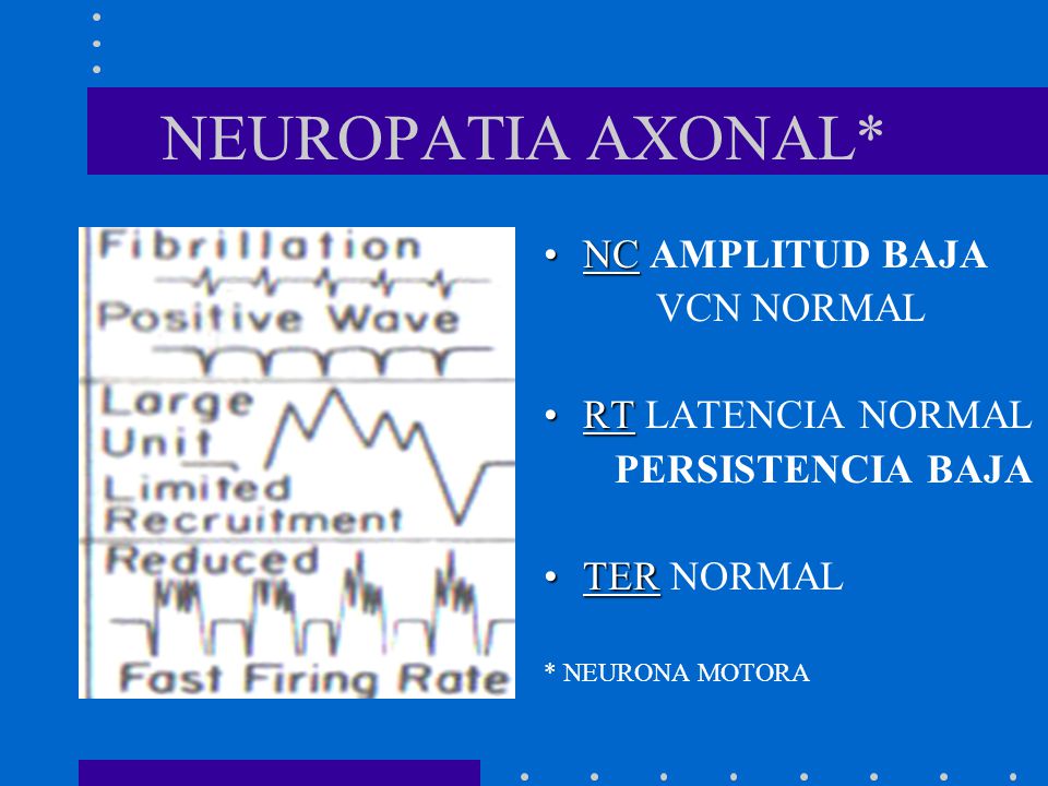 NEUROPATIA AXONAL* NC AMPLITUD BAJA VCN NORMAL RT LATENCIA NORMAL