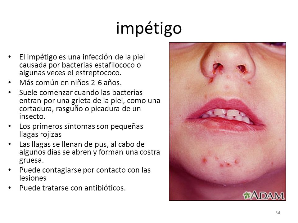 impétigo El impétigo es una infección de la piel causada por bacterias estafilococo o algunas veces el estreptococo.