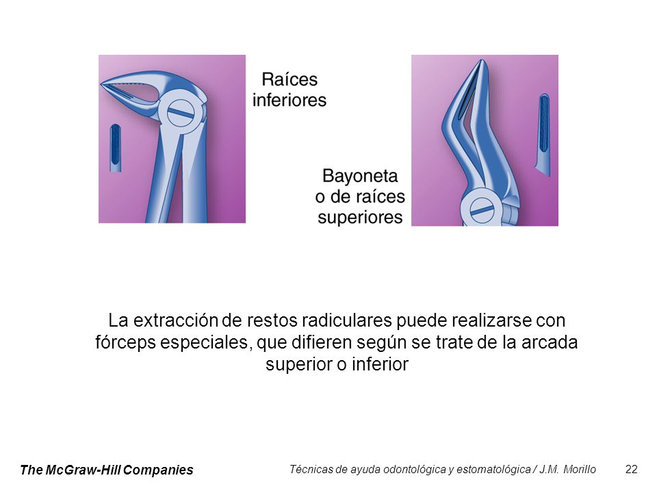 La extracción de restos radiculares puede realizarse con fórceps especiales, que difieren según se trate de la arcada superior o inferior