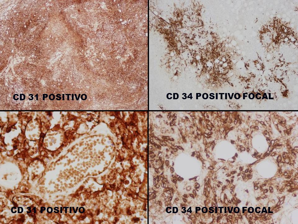 CD 31 POSITIVO CD 34 POSITIVO FOCAL CD 31 POSITIVO CD 34 POSITIVO FOCAL