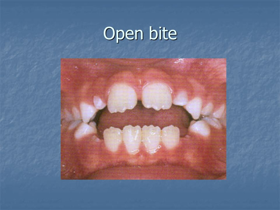 Open bite
