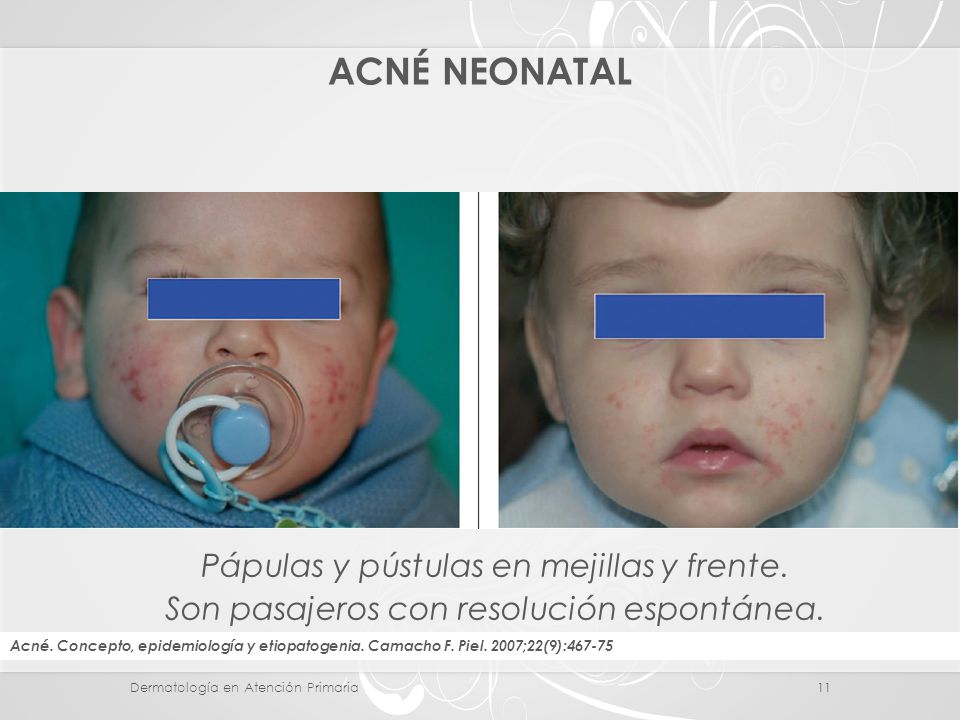 ACNÉ NEONATAL Pápulas y pústulas en mejillas y frente.