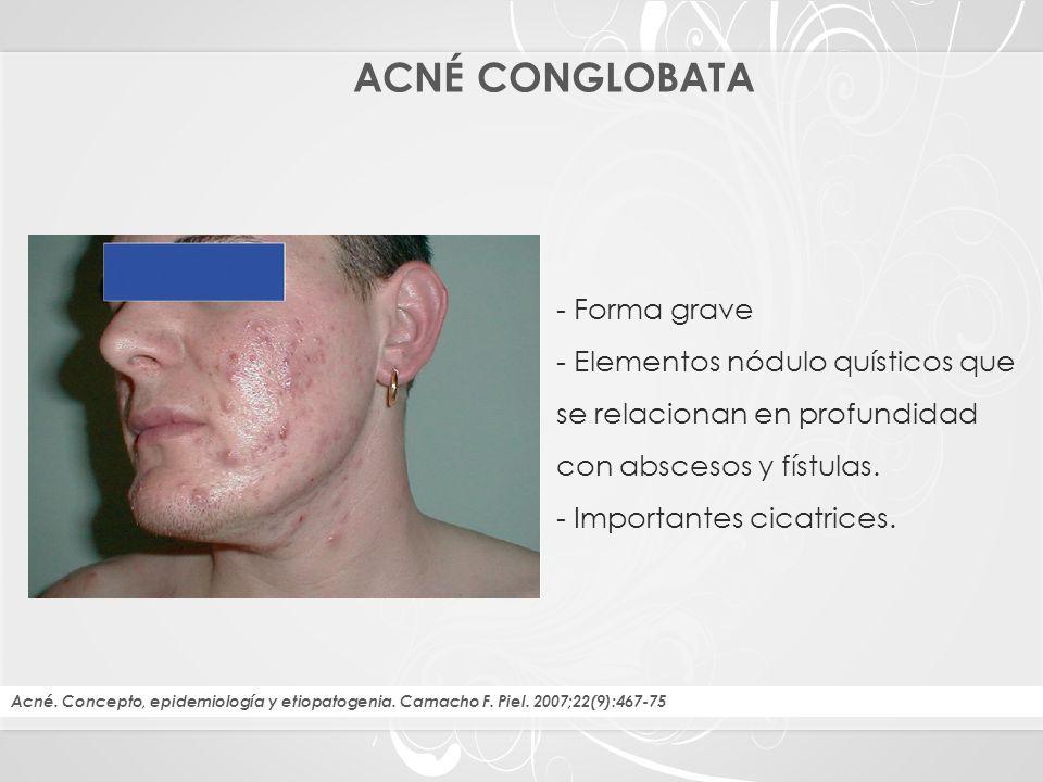 ACNÉ CONGLOBATA - Forma grave - Elementos nódulo quísticos que se relacionan en profundidad con abscesos y fístulas. - Importantes cicatrices.